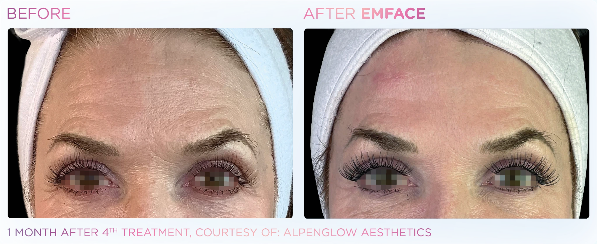 EMFACE before and after results for the forehead and eye area