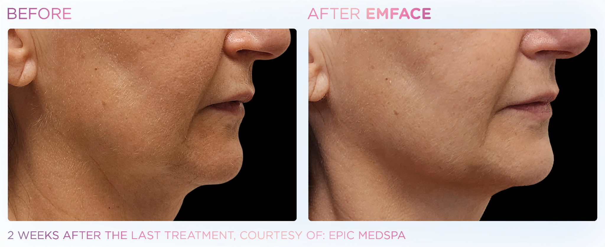 EMFACE before and after results for the jawline and lower face