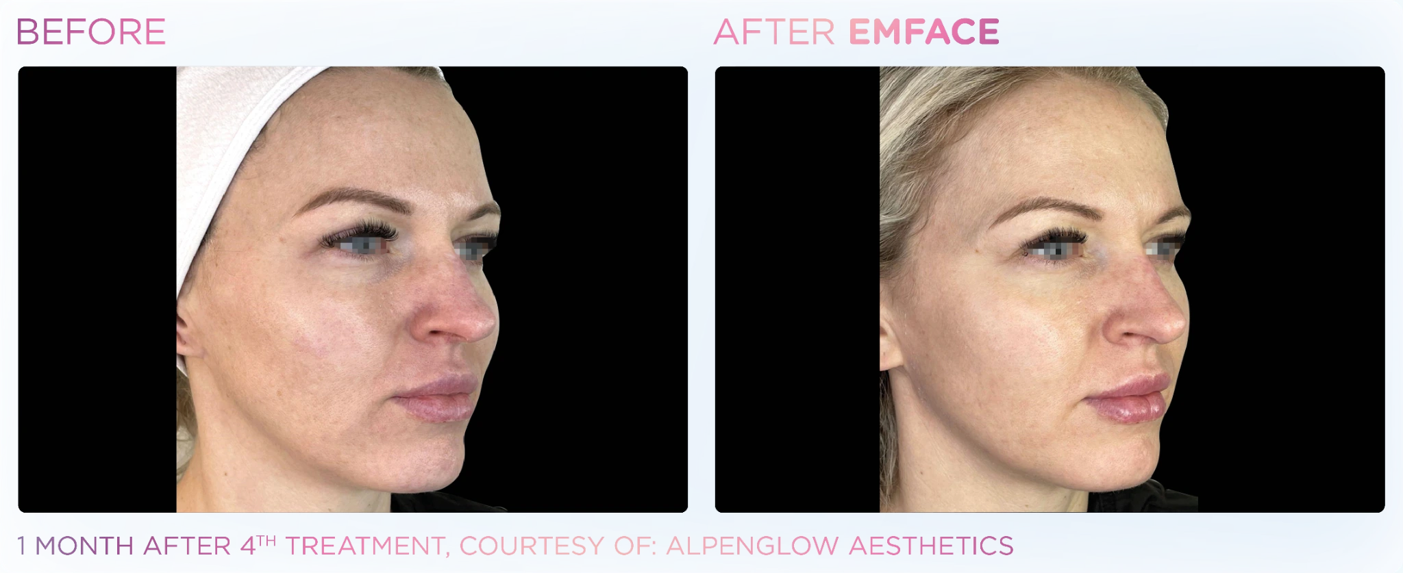 EMFACE before and after results shown in side-by-side facial photos