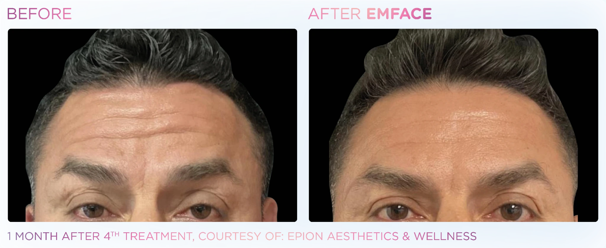 EMFACE before and after results for the forehead and upper face