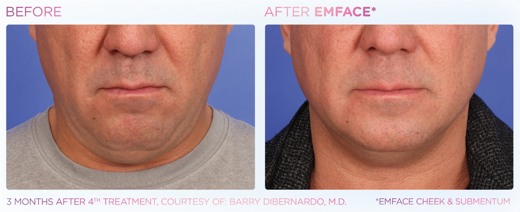 EMFACE before and after results for lower face and neck