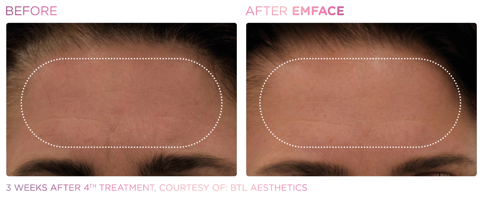 EMFACE before and after results shown in a forehead comparison