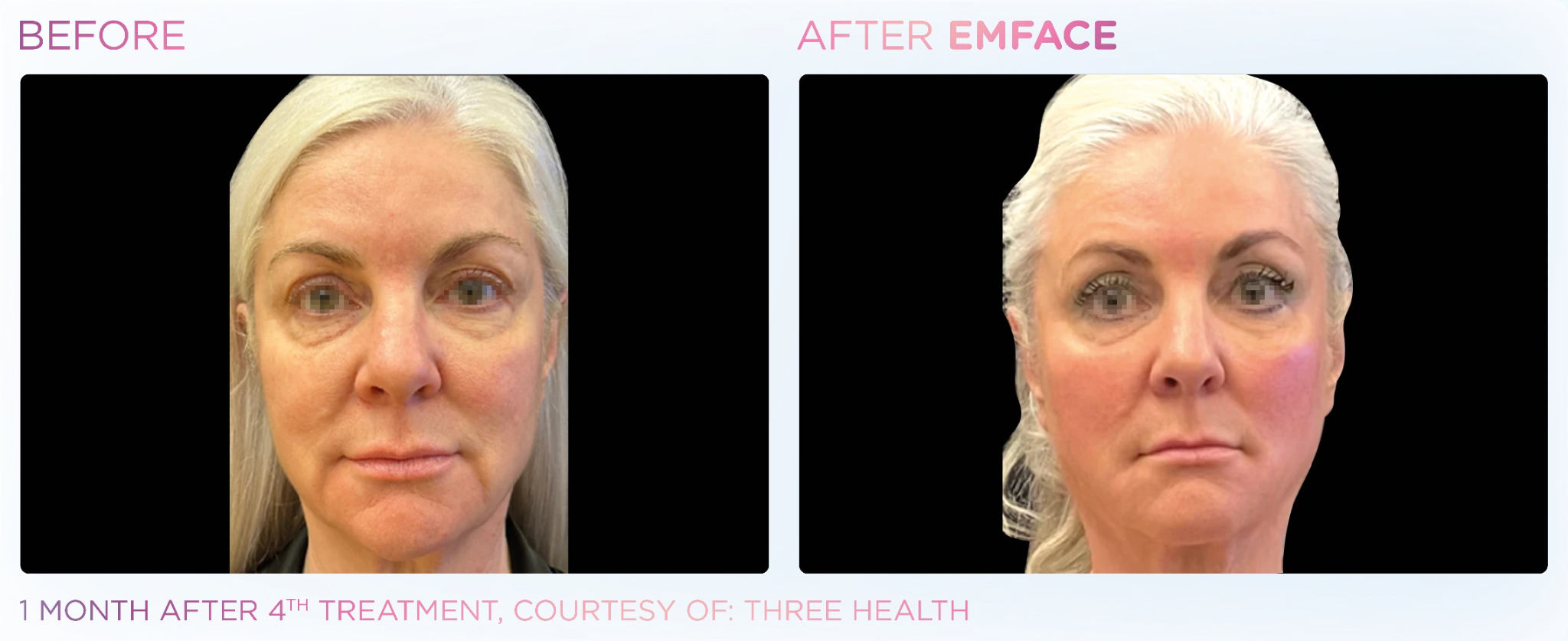 Front-facing EMFACE before and after facial comparison